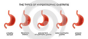 The types of hypertrophic gastritis