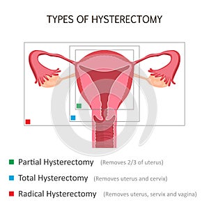 Types of Hysterectomy photo