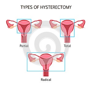 Types of Hysterectomy photo