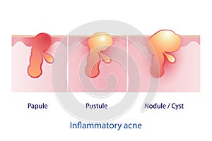 Types of inflammatory acne, papule, pustule, nodule and cyst vector on white background. photo