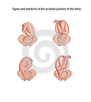 types of insertion of the fetal head in obstetrics