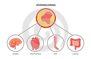 Types of ishemia