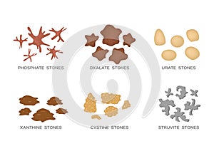 Types of kidney stone 6 set