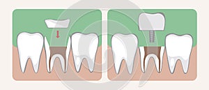 Types of Microprosthesis and Tooth Implantation, Flat Vector Stock Illustration or Collage with Ceramic Crown or Inlay