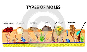 Types of moles. Nevus, pigment spot, papilloma, wart, keratoma, atheroma, hemangeoma. Mole. Anatomical structure of the