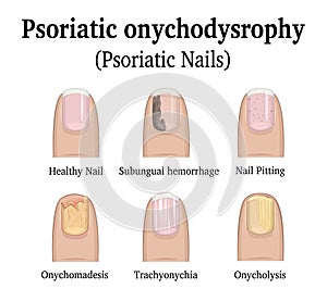 Types of nail psoriasis