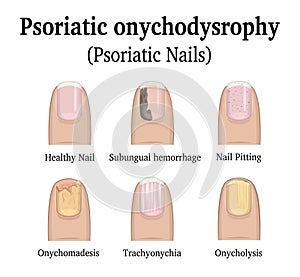 Types of nail psoriasis photo