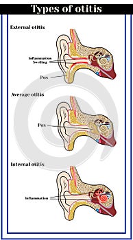 Types of otitis : external, average and internal otitis. photo