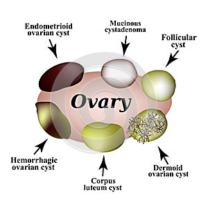 Types of ovarian cysts. Set. Infographics. Vector illustration on isolated background.