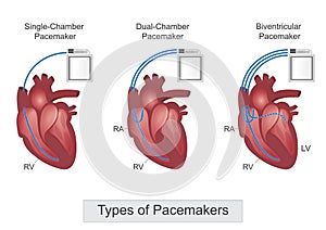 Types of pacemaker