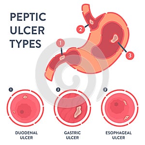 Types of peptic ulcer stomach disease infographics