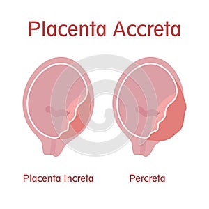Types of placenta accreta: Placenta Increta and Percreta