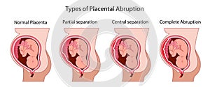 Types of Placental Abruption