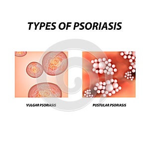 Types of psoriasis. Not pustular and pustular psoriasis. Eczema, skin disease dermatitis. Infographics. Vector photo