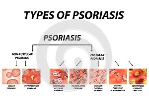 Types of psoriasis. Pustular and not pustular. Vulgar, erythroderma, erythrodermic psoriasis, persistent acrodermatitis photo