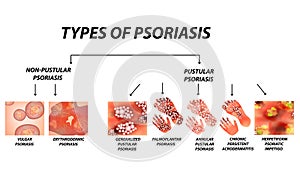 Types of psoriasis. Pustular and not pustular. Vulgar, erythroderma, erythrodermic psoriasis, persistent acrodermatitis photo