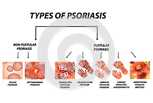 Types of psoriasis. Pustular and not pustular. Vulgar, erythroderma, erythrodermic psoriasis, persistent acrodermatitis photo