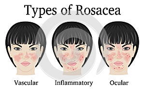 Types of Rosacea