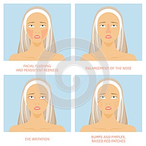 Types of rosacea. Four subtypes and their characteristics.