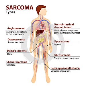 Types sarcoma photo