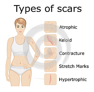 Types of scars