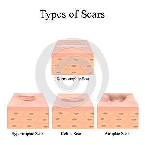 Types of scars. Acne scars. Keloid, hypertrophic, atrophic, normotrophic. The anatomical structure of the skin with acne photo