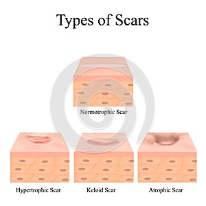 Types of scars. Acne scars. Keloid, hypertrophic, atrophic, normotrophic. The anatomical structure of the skin with acne