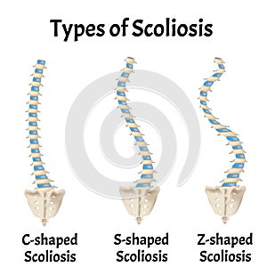 Types of Scoliosis. C, S, Z shaped scoliosis. Dextroscoliosis. Levoscoliosis. Spinal curvature, kyphosis, lordosis