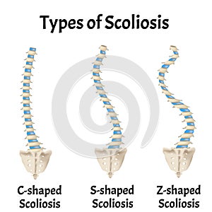 Types of Scoliosis. C, S, Z shaped scoliosis. Dextroscoliosis. Levoscoliosis. Spinal curvature, kyphosis, lordosis photo