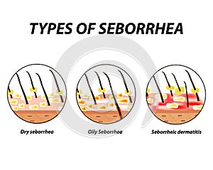 Types of seborrhea. Seborrhea skin and hair. Dandruff, seborrheic dermatitis. Baldness, hair growth, baldness