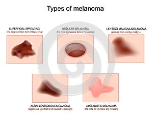 Types of  melanoma photo