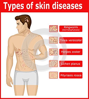 Types of skin diseases photo