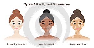 Types of skin pigment discoloration vector isolated on white background.