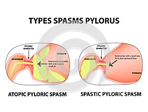 Types of spasms of the pylorus. Pylorospasm. Spastic and atonic. Pyloric sphincter of the stomach. Infographics. Vector photo