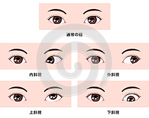 Types of strabismus vector illustration