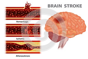 Types of stroke. Vector illustration