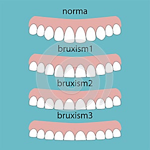 Types of teeth erasability. Layout attrition Bruxism teeth illustration vector. Erased teeth. Dental concept