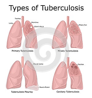 Types of Tuberculosis photo