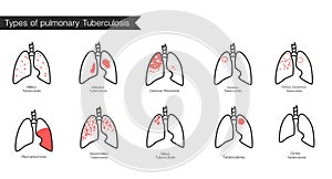 Types of tuberculosis. Vector silhouette medical illustration of human body organ lungs with trachea. Poster for clinic, hospital