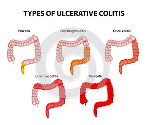 Types of Ulcerative Colitis photo