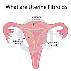 Types of Uterine Fibroids