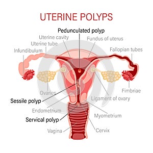 Types of uterine polyps. Diseases of the female reproductive system. Gynecology. Medical concept. Infographic banner.