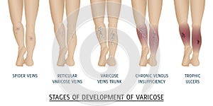 Types of varicose veins in women.