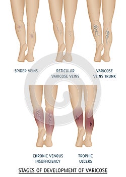 Types of varicose veins in women. Stages of development of varicose veins, vector illustration.