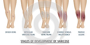 Types of varicose veins in women. photo