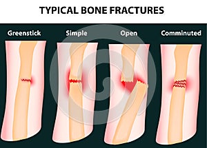 Típico hueso fracturas 