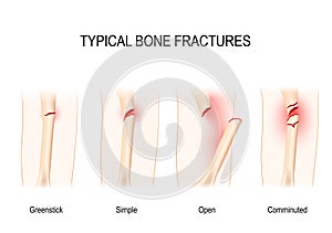 Typical bone fractures. for medical use