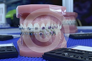 Typodont plastic moulage of human jaws demonstrating dental braces on teeth