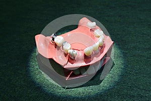 Typodont plastic moulage of human jaws demonstrating dental braces on teeth