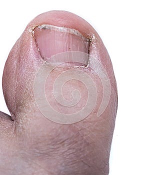 Ugly, Dirty, Weird Big Toe. Close up on white background